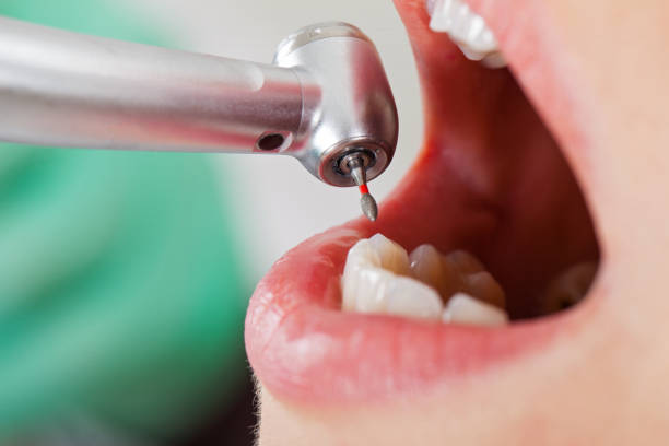 Best Emergency Wisdom Teeth Removal in Pearland, TX